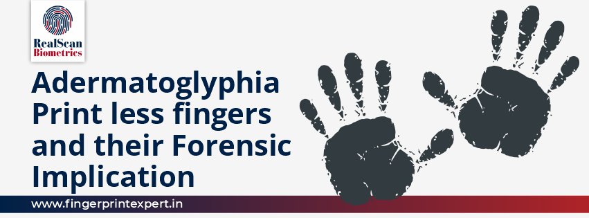 Adermatoglyphia | Print less Fingers and Their Forensic Implication